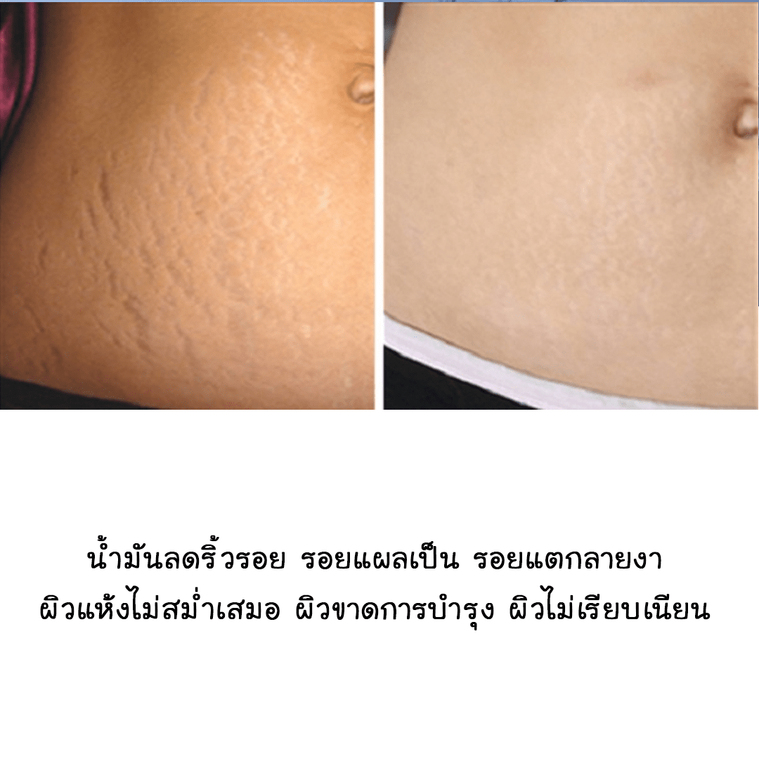 ?12848 ชุดทำน้ำมันทาท้องแก้ท้องแตกลาย - 1kg